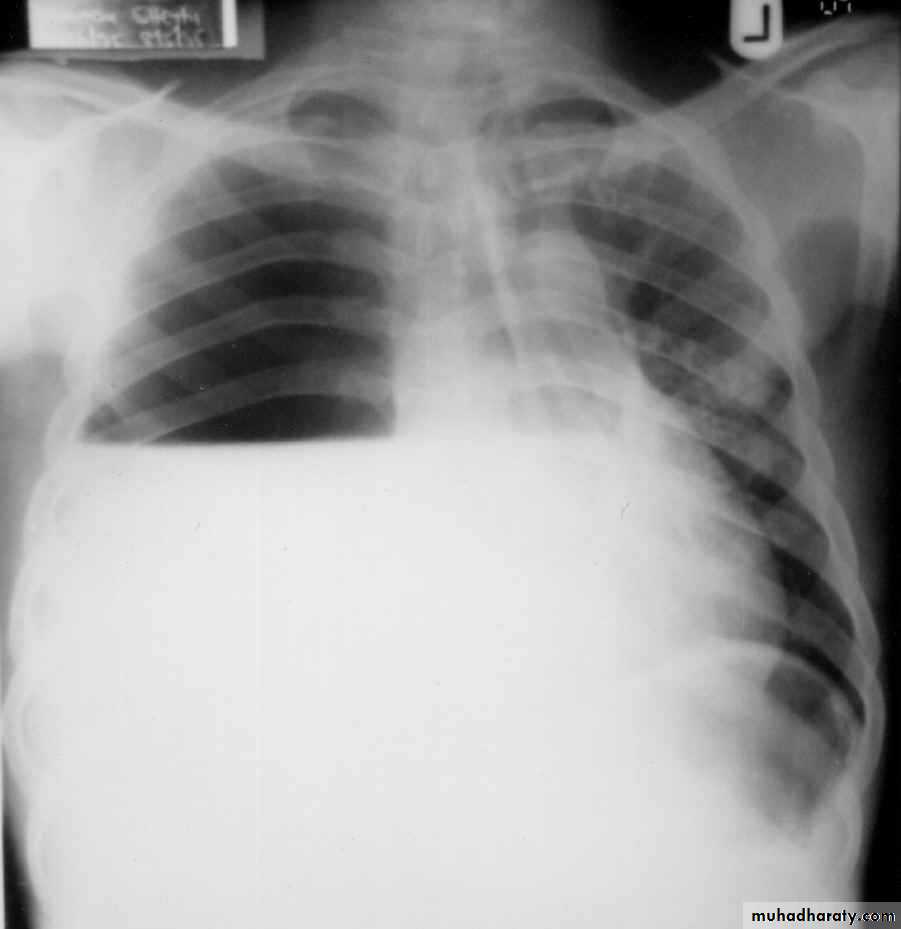 Pleural effusion
