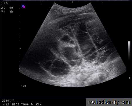 Pleural effusion