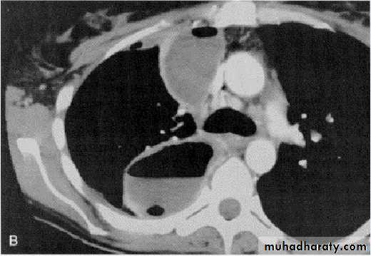 Pleural effusion