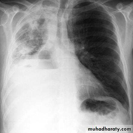 Pleural effusion