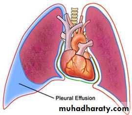 Pleural effusion