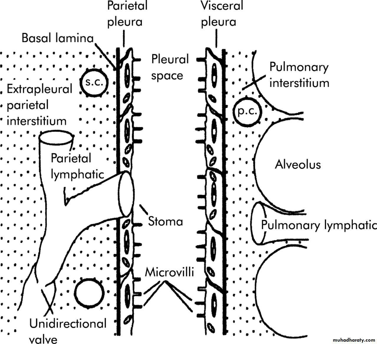 Pleural effusion
