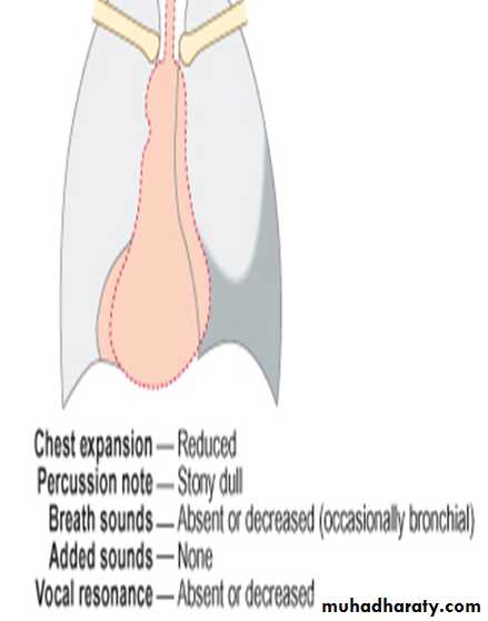 Pleural effusion
