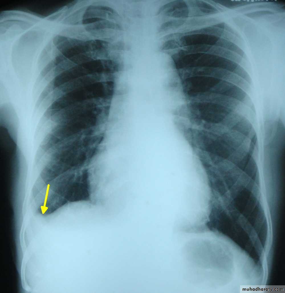 Pleural effusion
