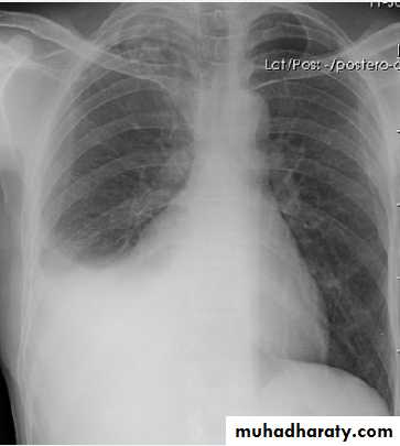 Pleural effusion