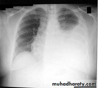 Pleural effusion