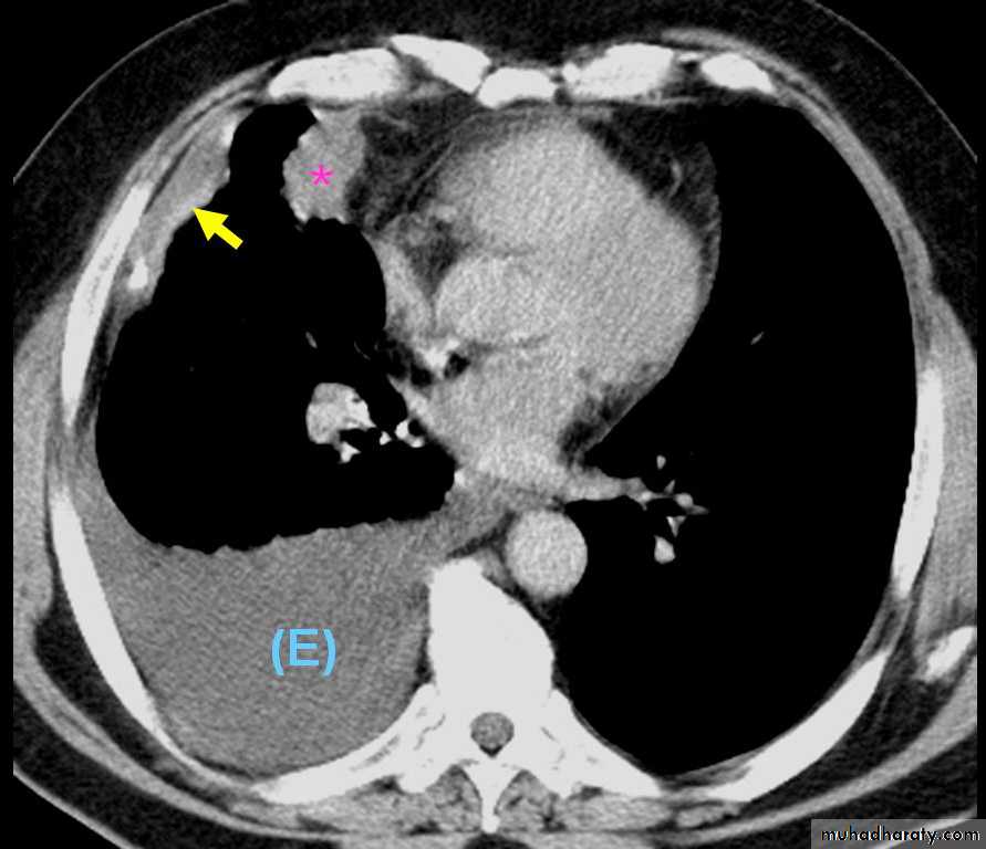 Pleural effusion