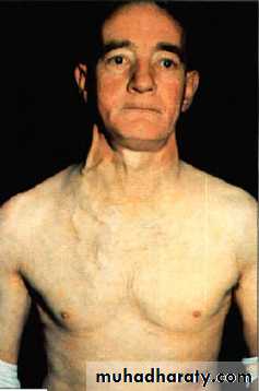 Lung cancer