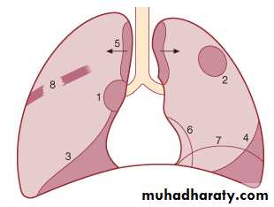 Lung cancer