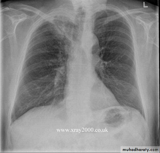 Lung cancer