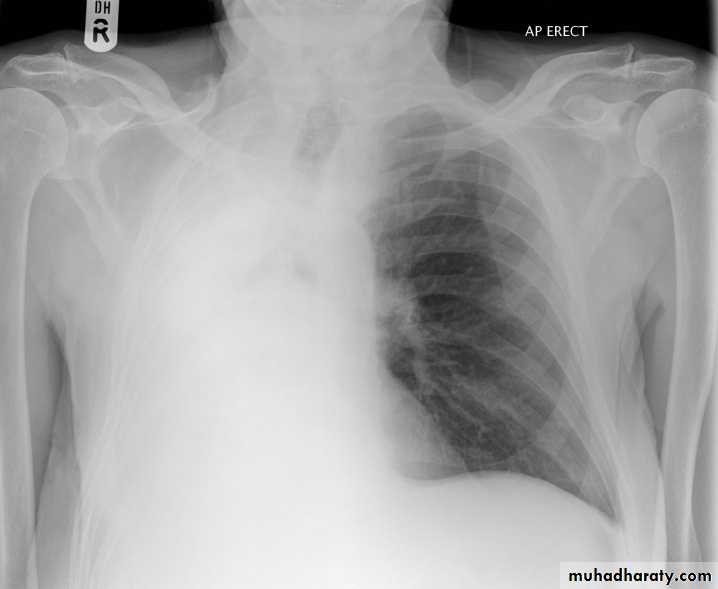 Lung cancer