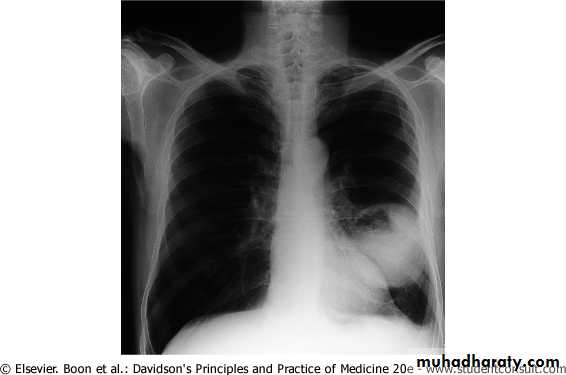 Lung cancer