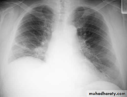 Lung cancer