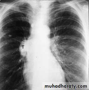 Lung cancer