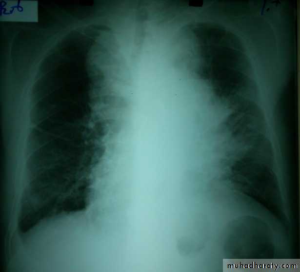 Lung cancer