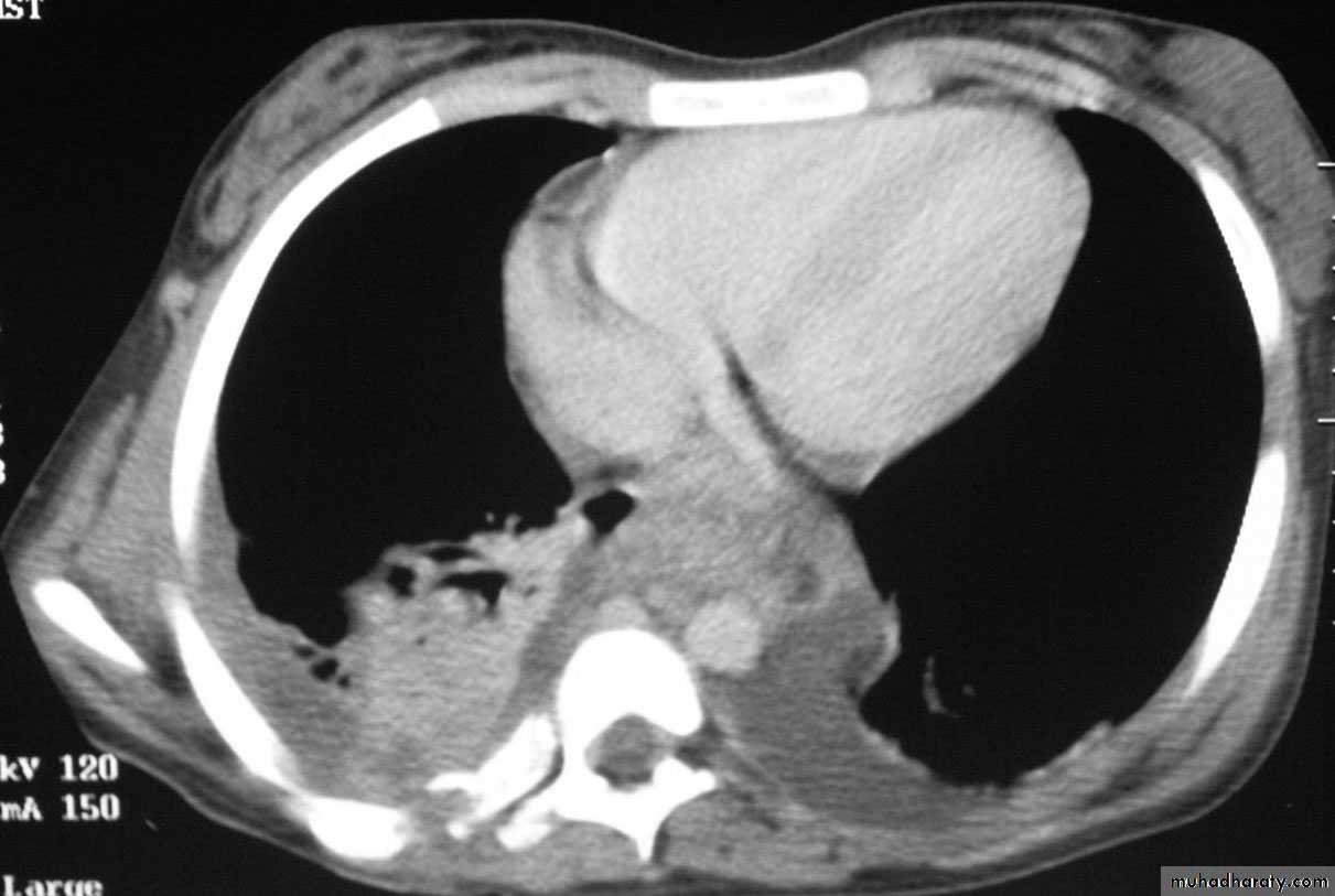 Lung cancer