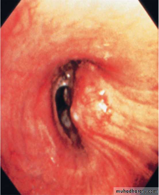 Lung cancer