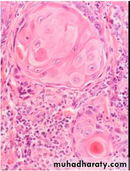 Lung cancer