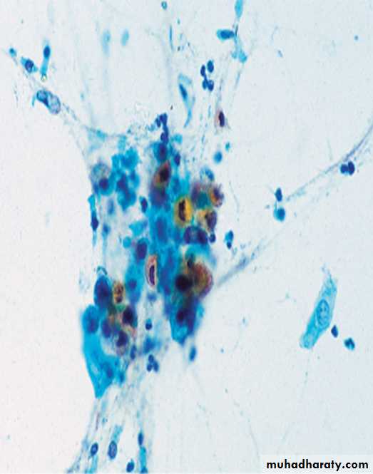 Lung cancer