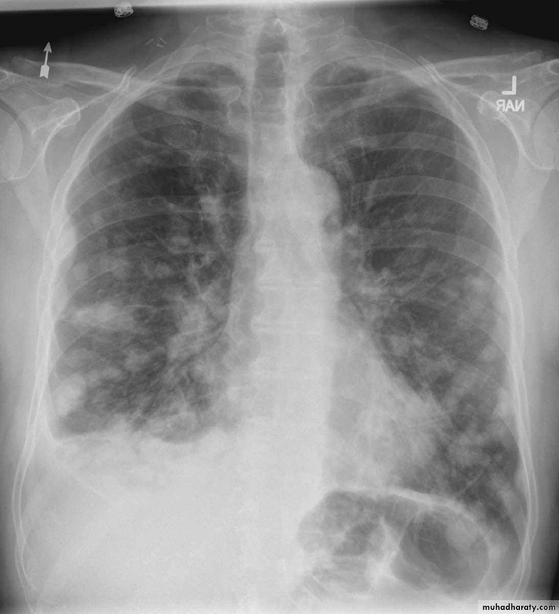 Lung cancer