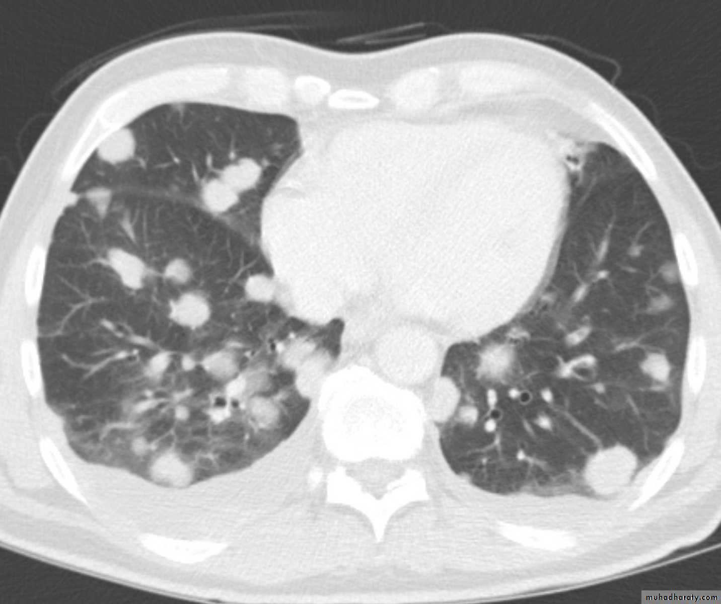 Lung cancer