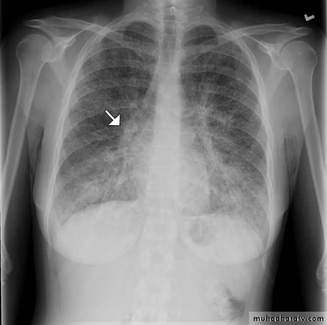 Lung cancer