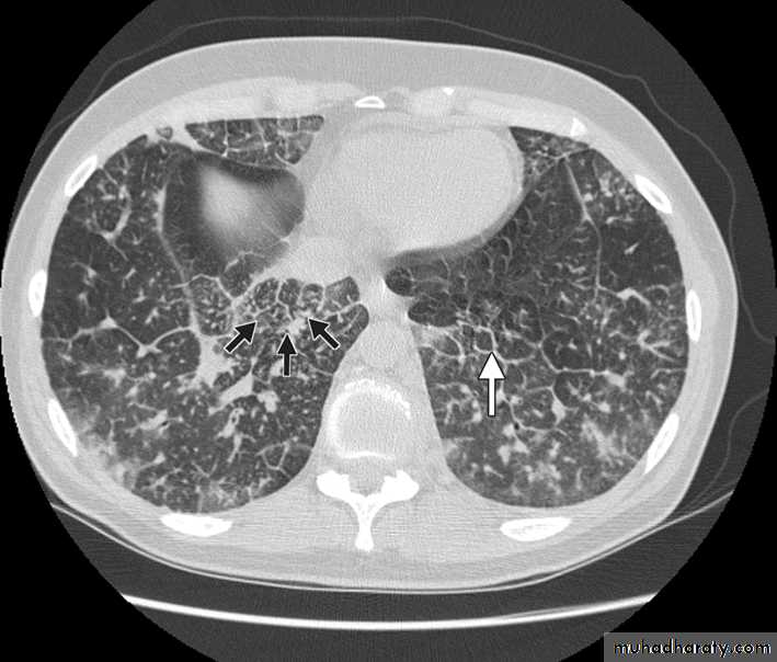 Lung cancer