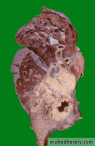 Lung cancer