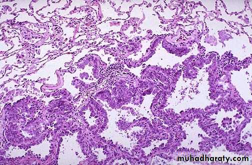 Lung cancer