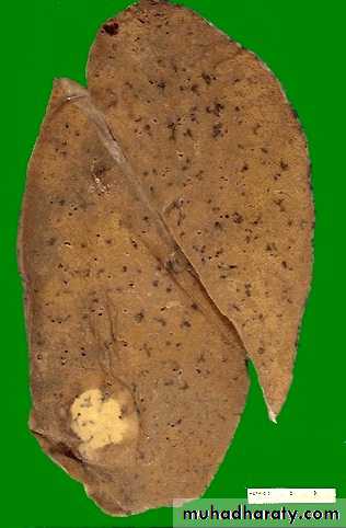 Lung cancer