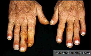 Lung cancer