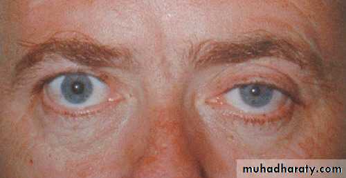 Lung cancer