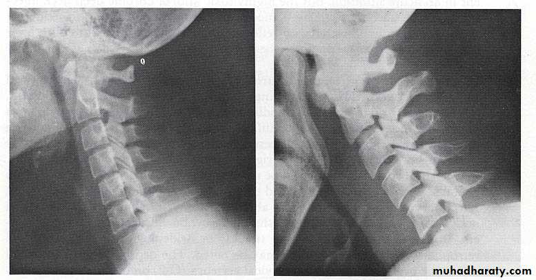 chronic pharyngitis