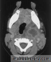 chronic pharyngitis