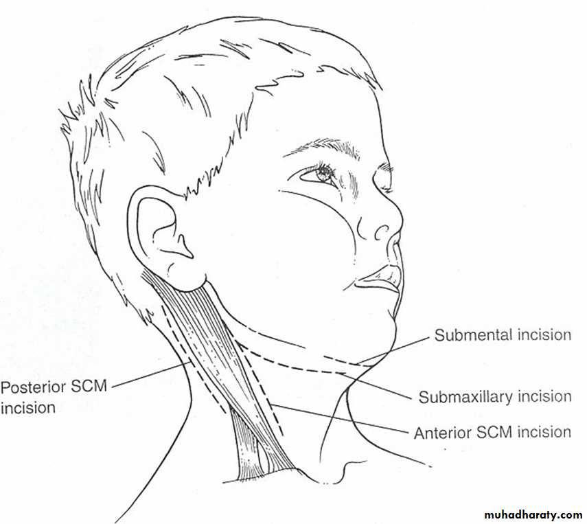 chronic pharyngitis