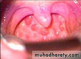 chronic pharyngitis