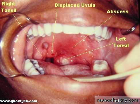 chronic pharyngitis