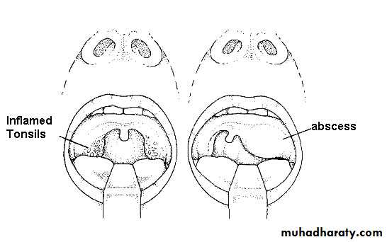 chronic pharyngitis