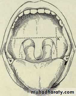 chronic pharyngitis