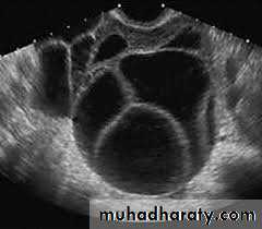 benign overian tumor