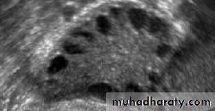 benign overian tumor