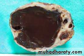 benign overian tumor