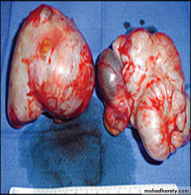 benign overian tumor
