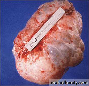 benign overian tumor