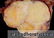 benign overian tumor