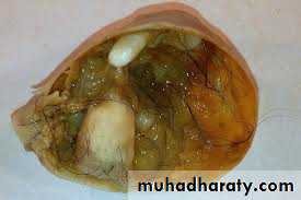 benign overian tumor