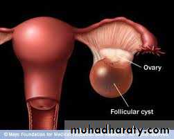 benign overian tumor