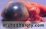 benign overian tumor