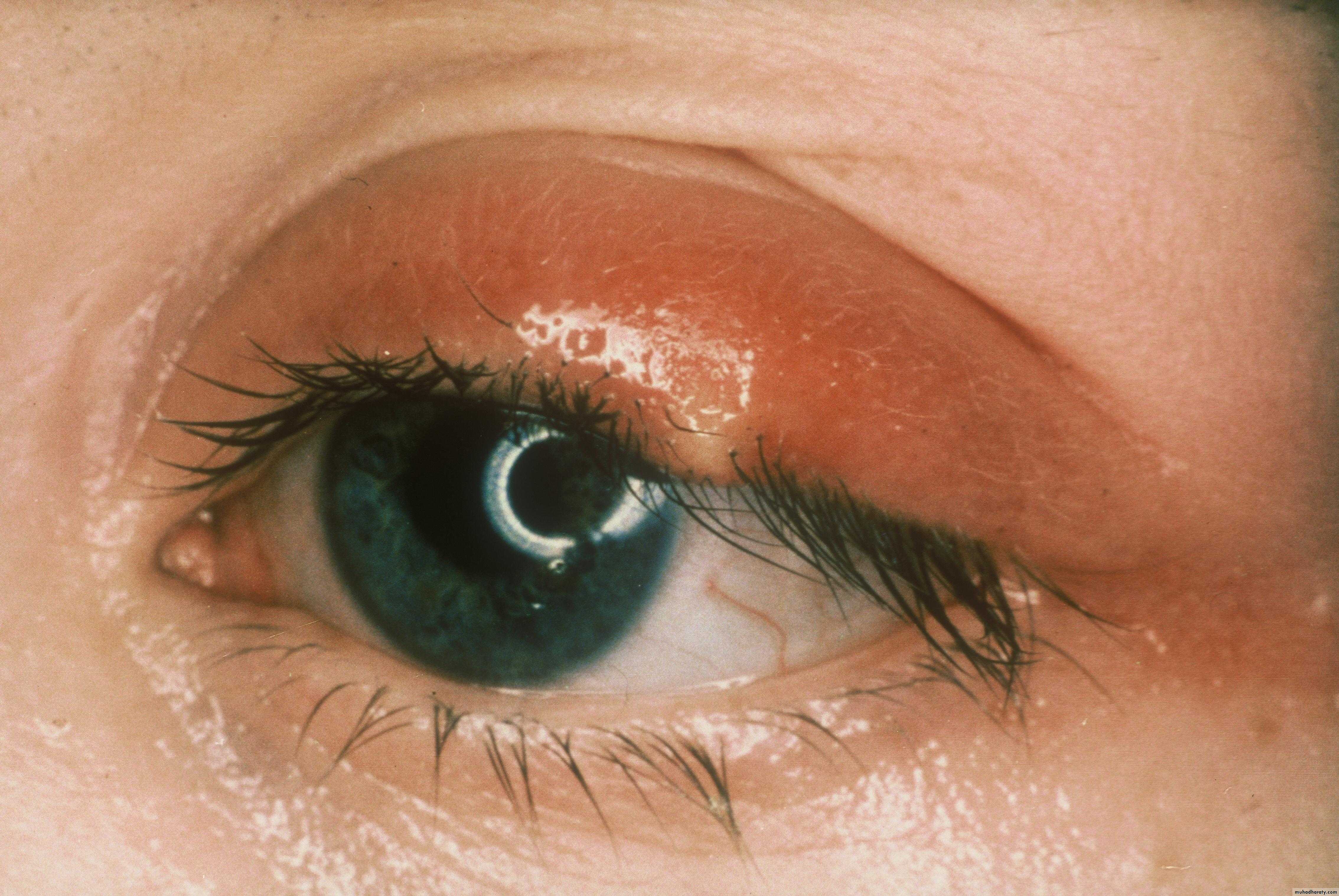 orbital and periorbital infectioun