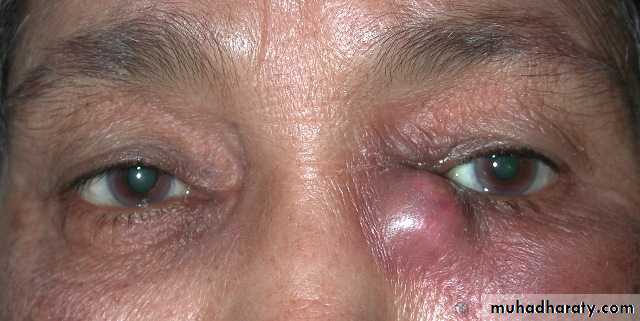 orbital and periorbital infectioun